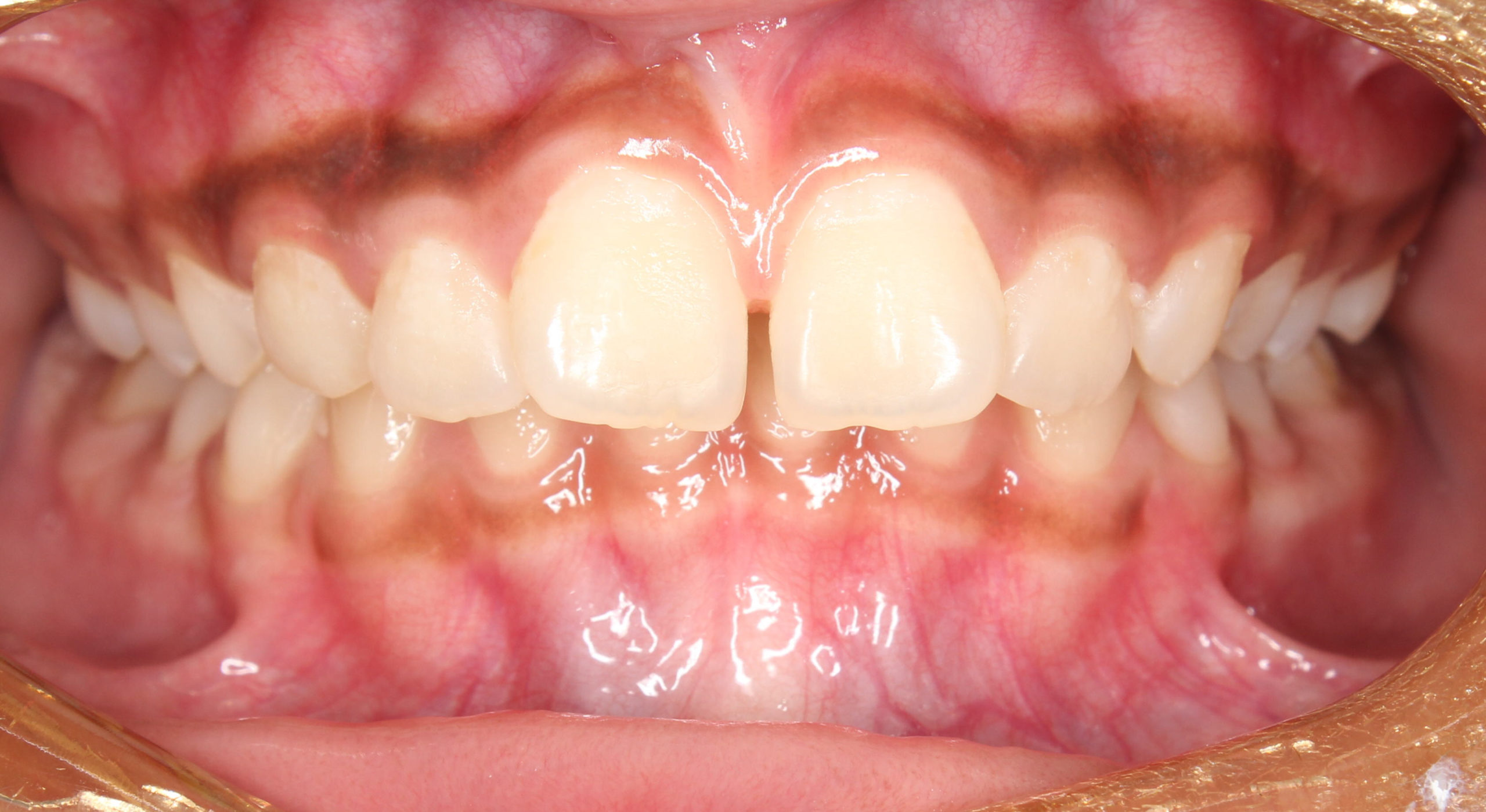 Large Overjet Flaring Spacing Before Orthodontics