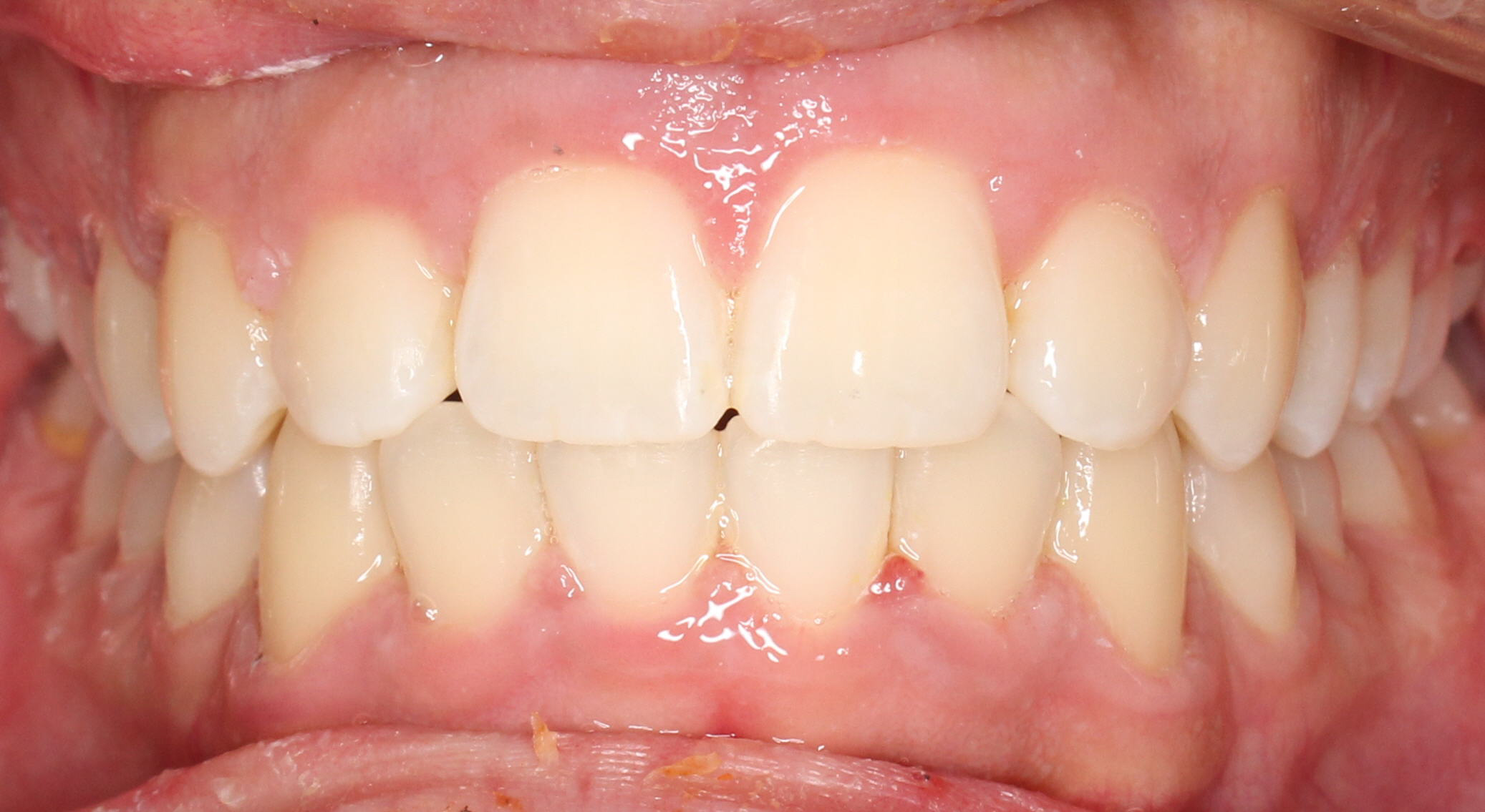 Deep Bite With Crowding After Orthodontics