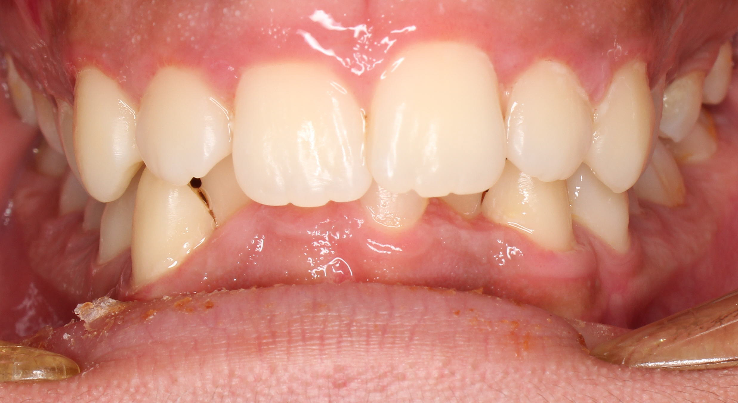 Deep Bite With Crowding Before Orthodontics